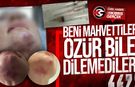Girne’de Özel Hastanede Dolgu Skandalı: “9 Aydır Enfeksiyonla Mücadele Ediyorum”
