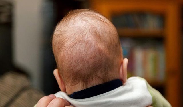 Bebeklerdeki kafa şekil bozukluğu sadece yatış pozisyonundan kaynaklanmayabilir!