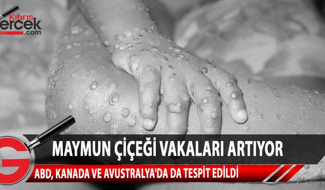 Maymun Çiçeği virüsü Avrupa ülkelerinin ardından ABD, Kanada ve  Avustralya'da da tespit edildi