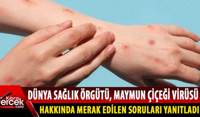Maymun çiçeği virüsü nedir, nasıl bulaşır, hastalığın tedavisi var mı?